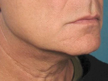 Ultherapy After