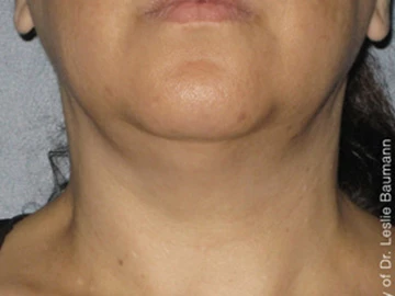 Ultherapy After