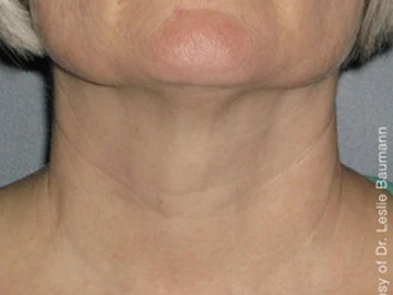 Ultherapy After
