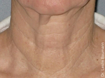 Ultherapy After