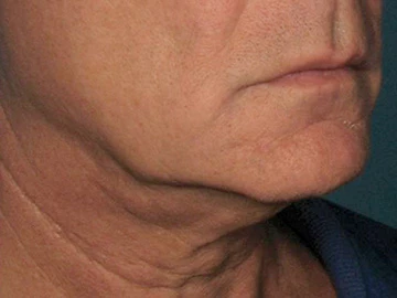 Ultherapy Before