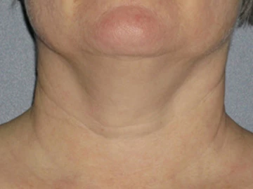 Ultherapy Before